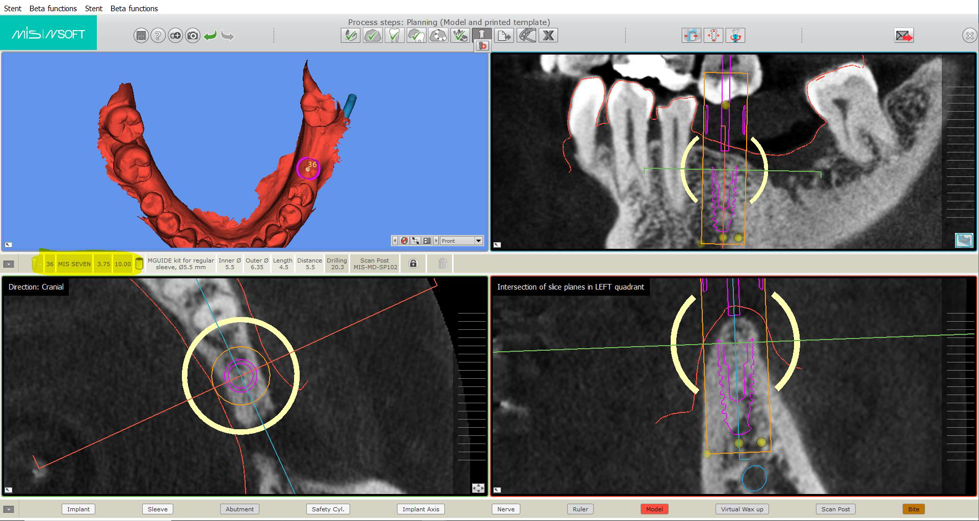 Digital Dental Implants