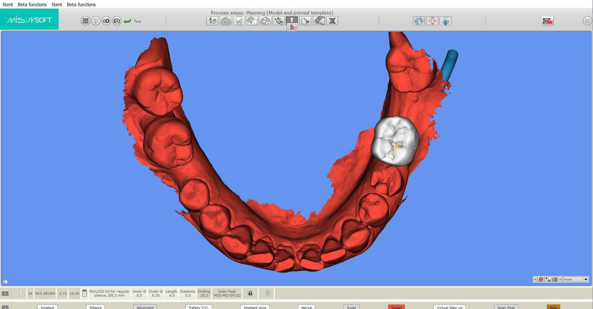 Digital Dental Implants