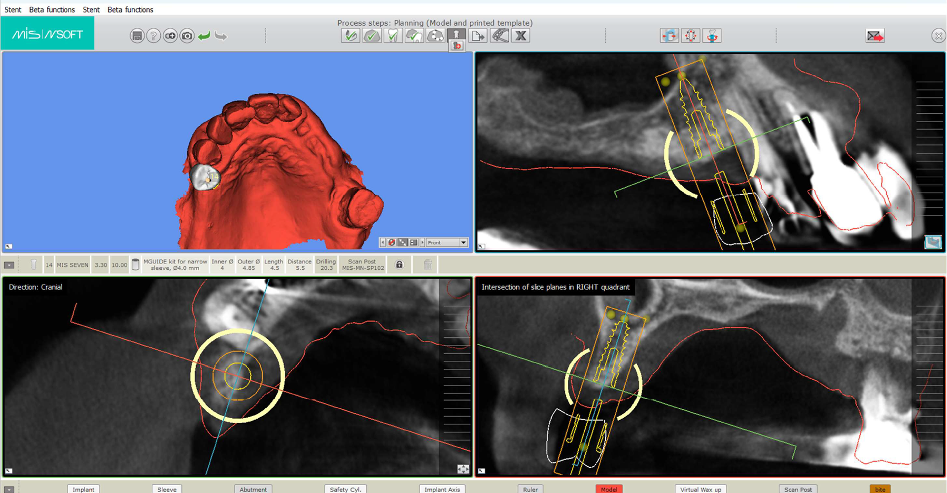 Digital Dental Implants