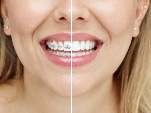 Clear Aligners For Teeth