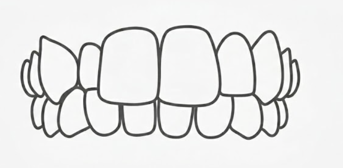 Crossbite