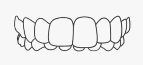Overbite