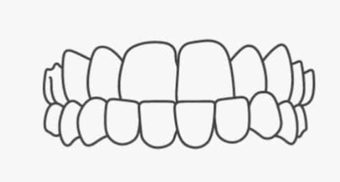 Underbite