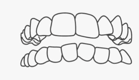 Crowded Teeth
