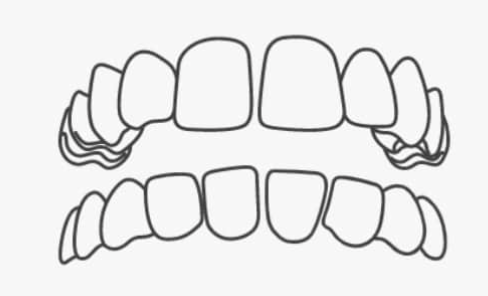 Gap Teeth