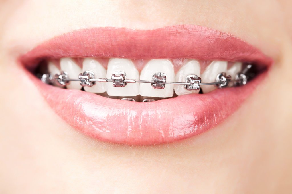 Traditional Braces