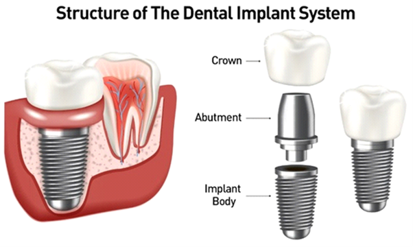 Structure of The Dental Implant System