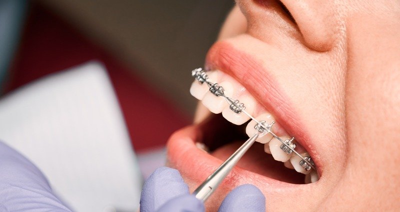 Dental Braces