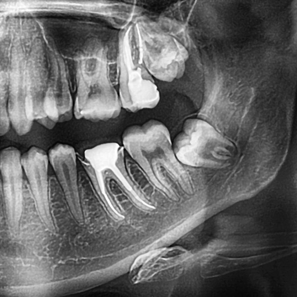 Wisdom Teeth X-Ray