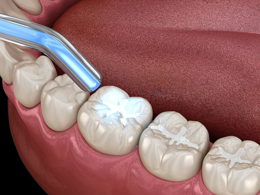 Tooth Coloured Filling