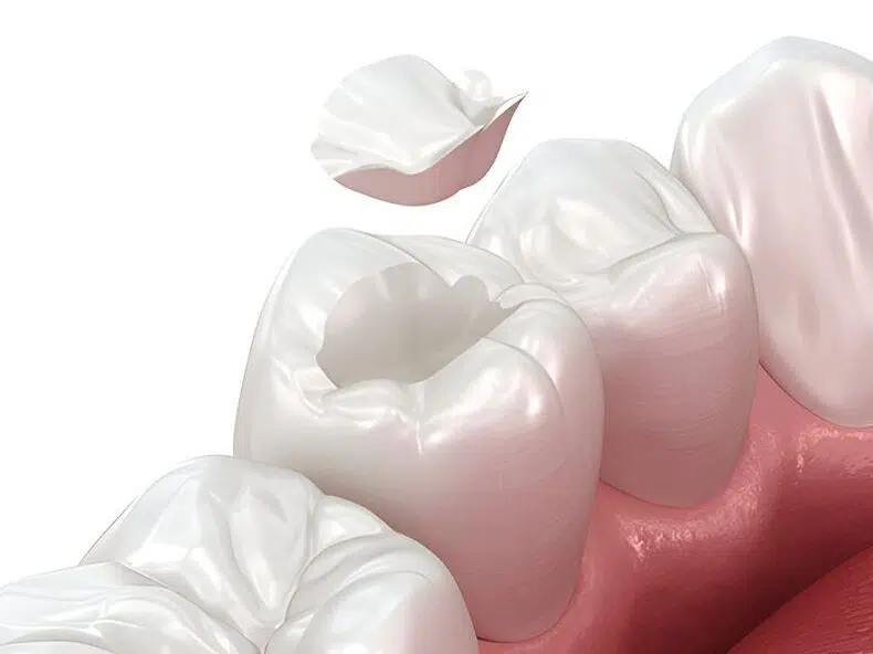 Composite Resin