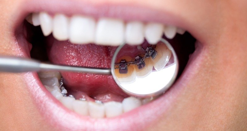 Internal Lingual Braces
