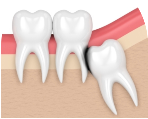 Damage To Nearby Molars