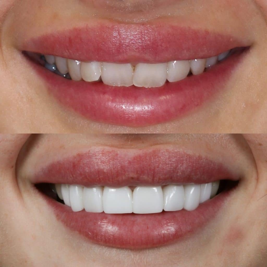 Before After veneers case 1