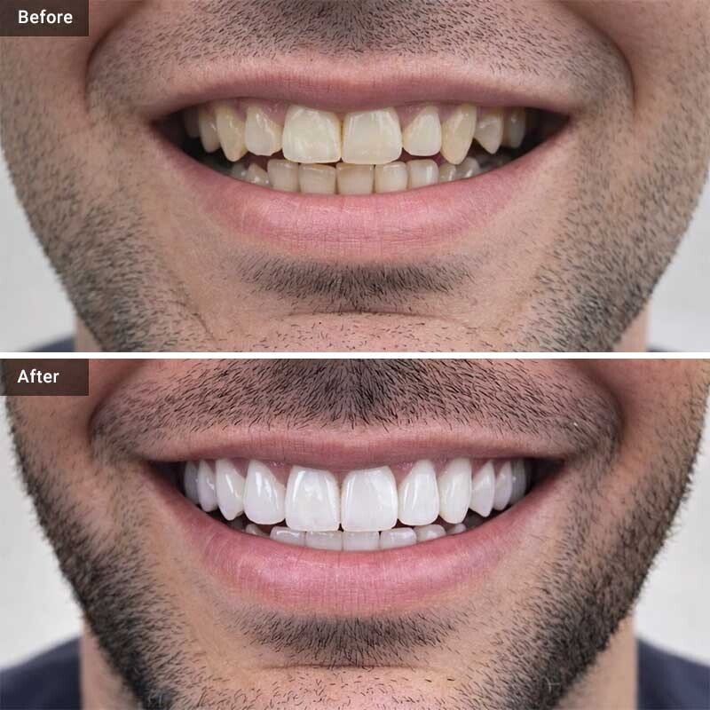 Before After veneers case 2