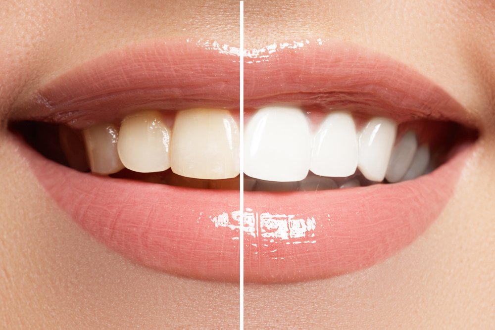 After whitening