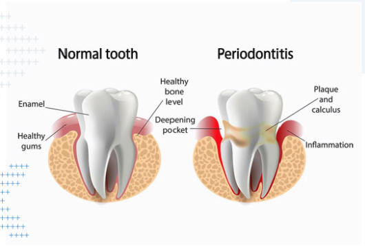 Cross-section comparison of a healthy tooth and one affected by periodontitis, showing enamel, healthy gums, plaque, calculus, deepening pocket and inflammation