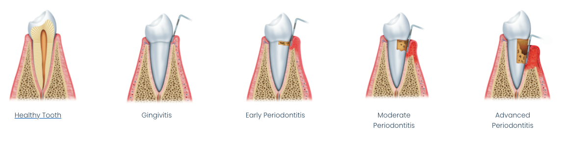 Five stages of periodontal disease progression: Healthy Tooth, Gingivitis, Early Periodontitis, Moderate Periodontitis, Advanced Periodontitis