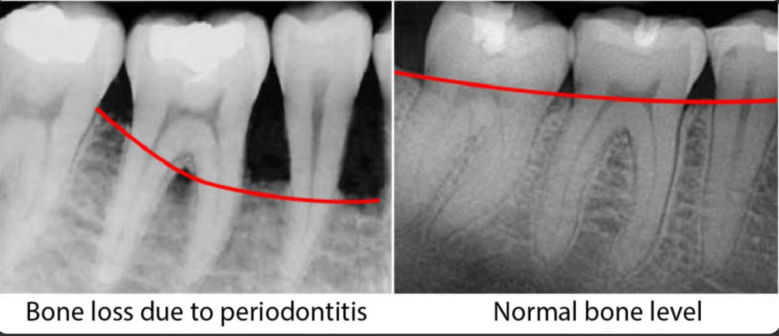 Dental X-ray showing bone loss due to periodontitis compared to normal bone level
