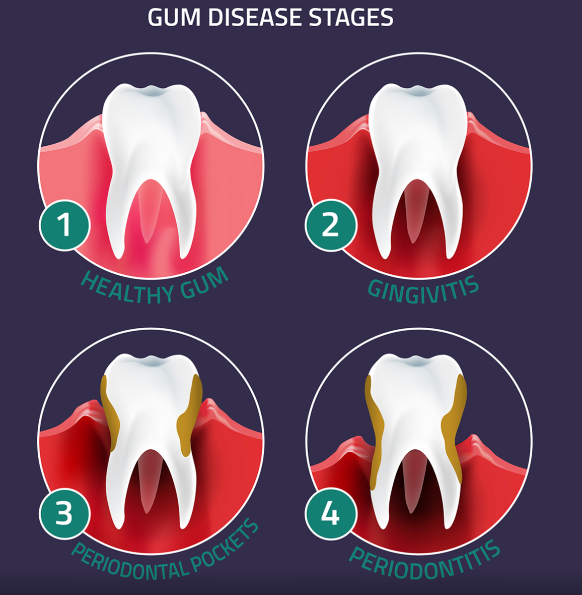 Four stages of gum disease: healthy gum, gingivitis, periodontal pockets, and periodontitis
