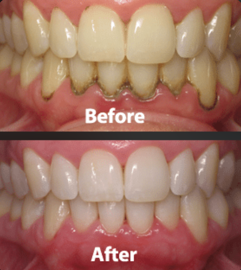 Before and after professional dental cleaning showing removal of calculus and staining