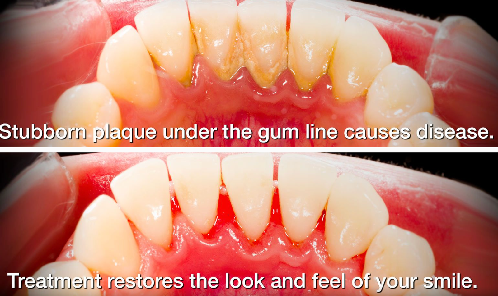 Before and after periodontal treatment showing plaque removal and restored gum health