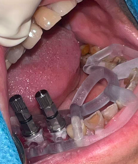 Guided implant planning