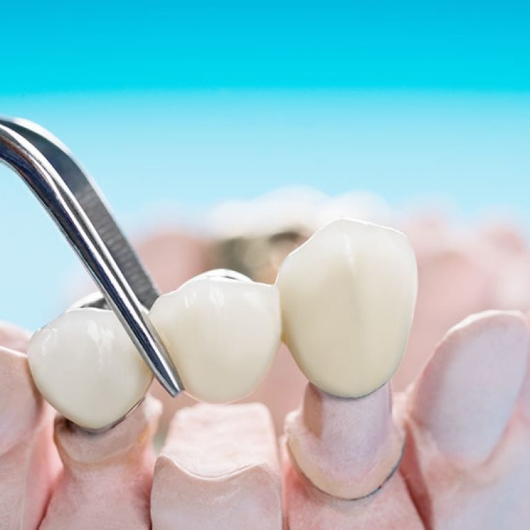 dental-bridges-img1