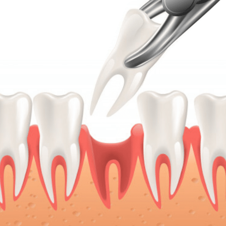 tooth-extraction-service